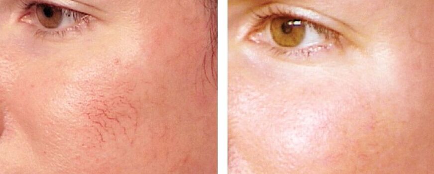 Removal of rosacea