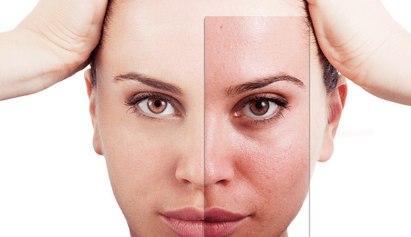 fractional rejuvenation removes the main aesthetic defects on the face